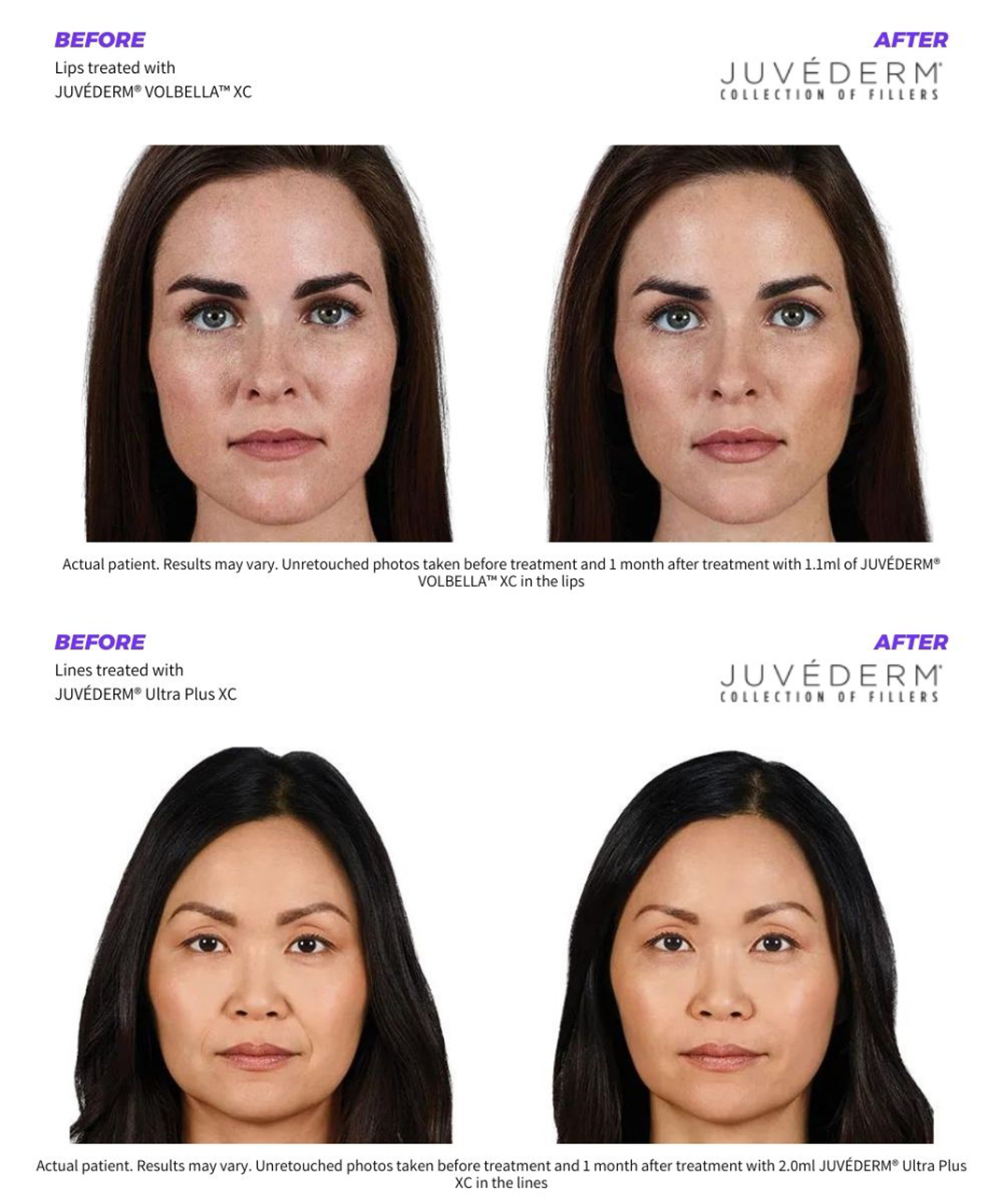 Before and after images of two women who have restored facial contours with Juvederm dermal fillers.