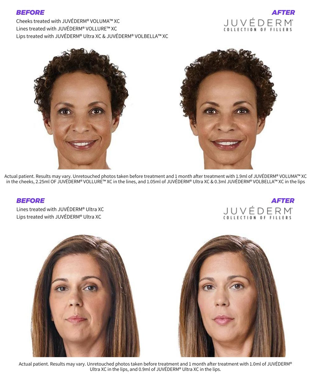 Before and after images of two women who have restored facial contours with Juvederm dermal fillers.