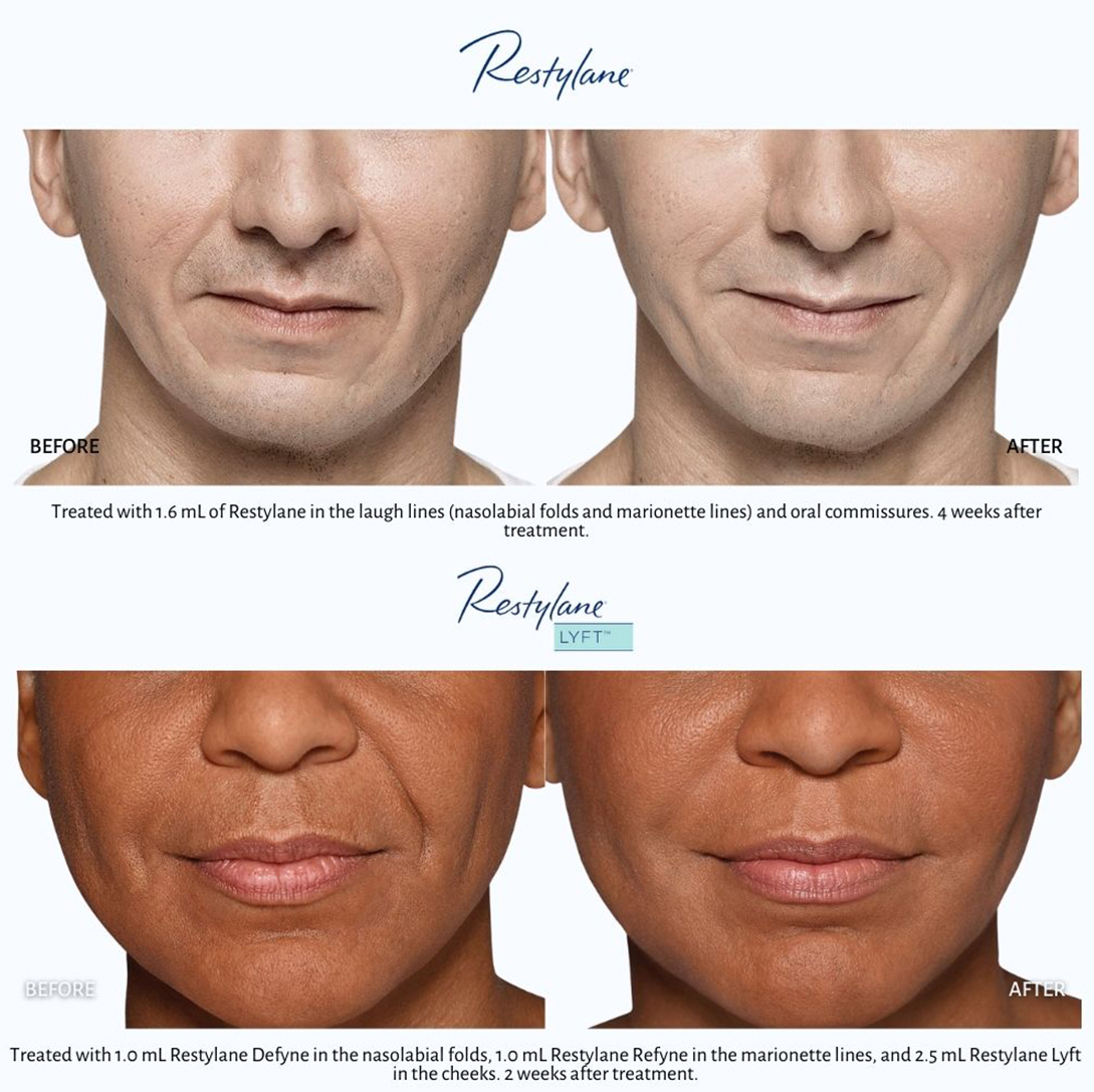 Before and after images of two men who have restored facial contours with Restylane dermal fillers.