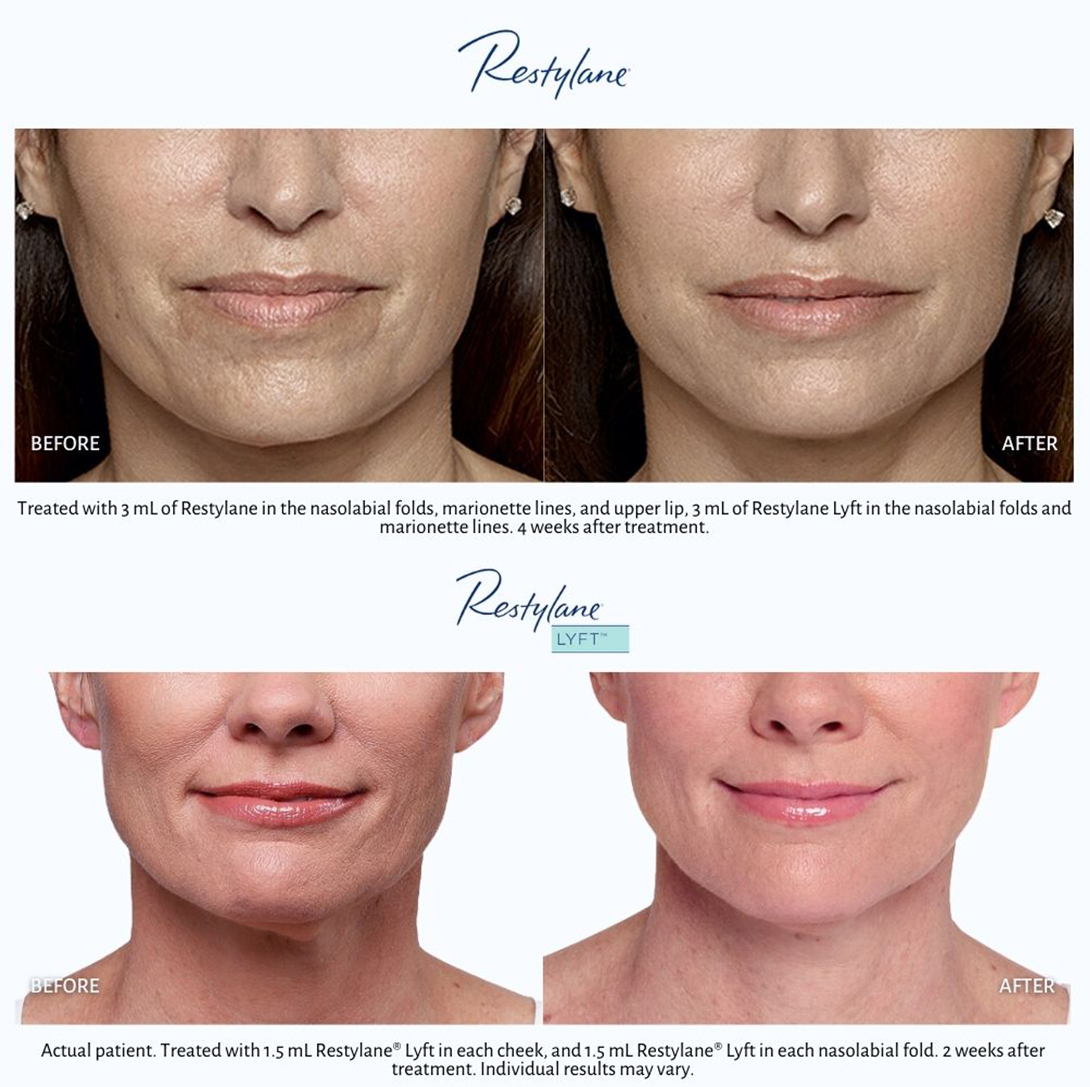 Before and after images of two women who have restored facial contours with Restylane dermal fillers.