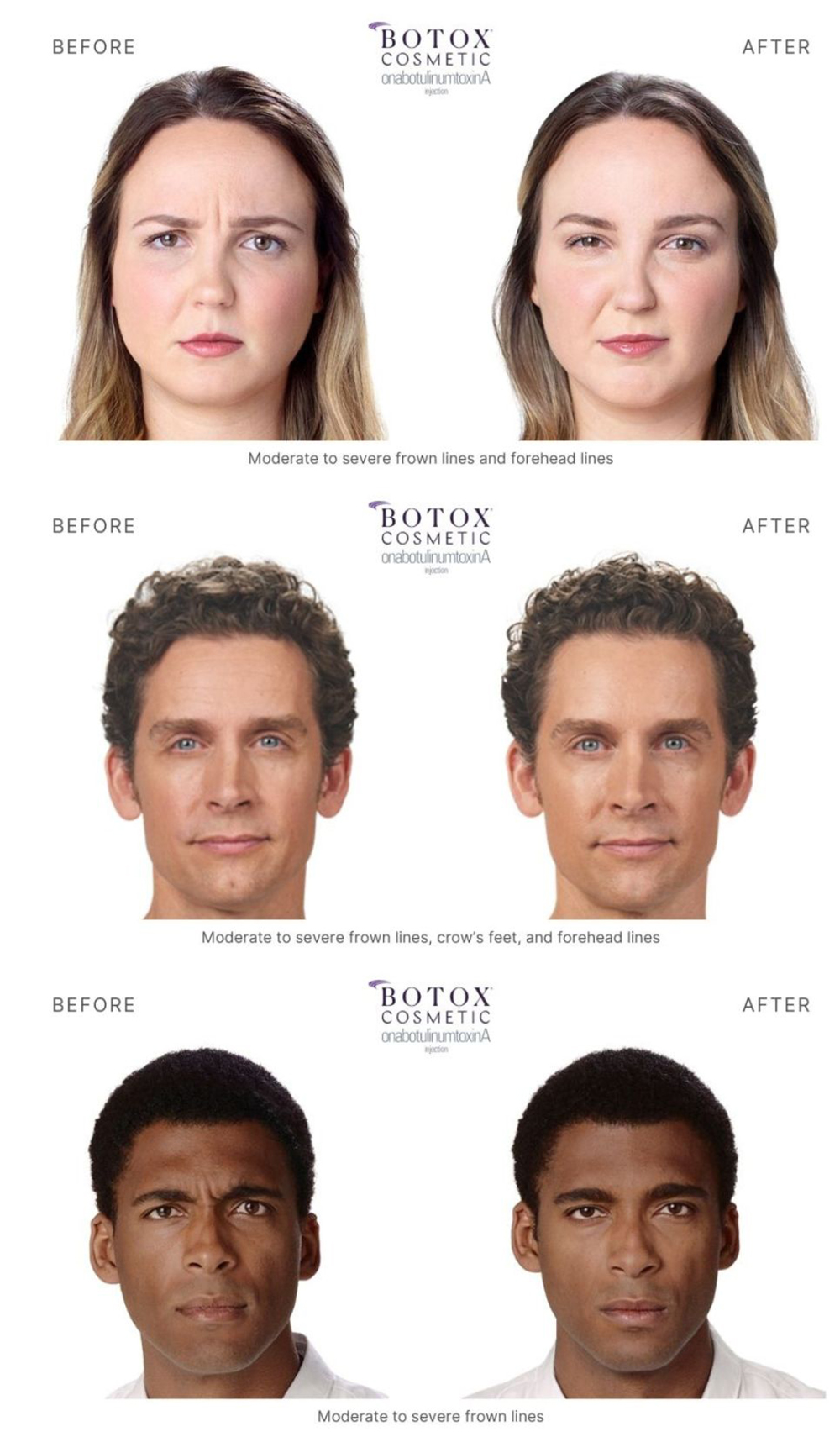 Before and after botox images of one woman and two men with restored youthful appearance.