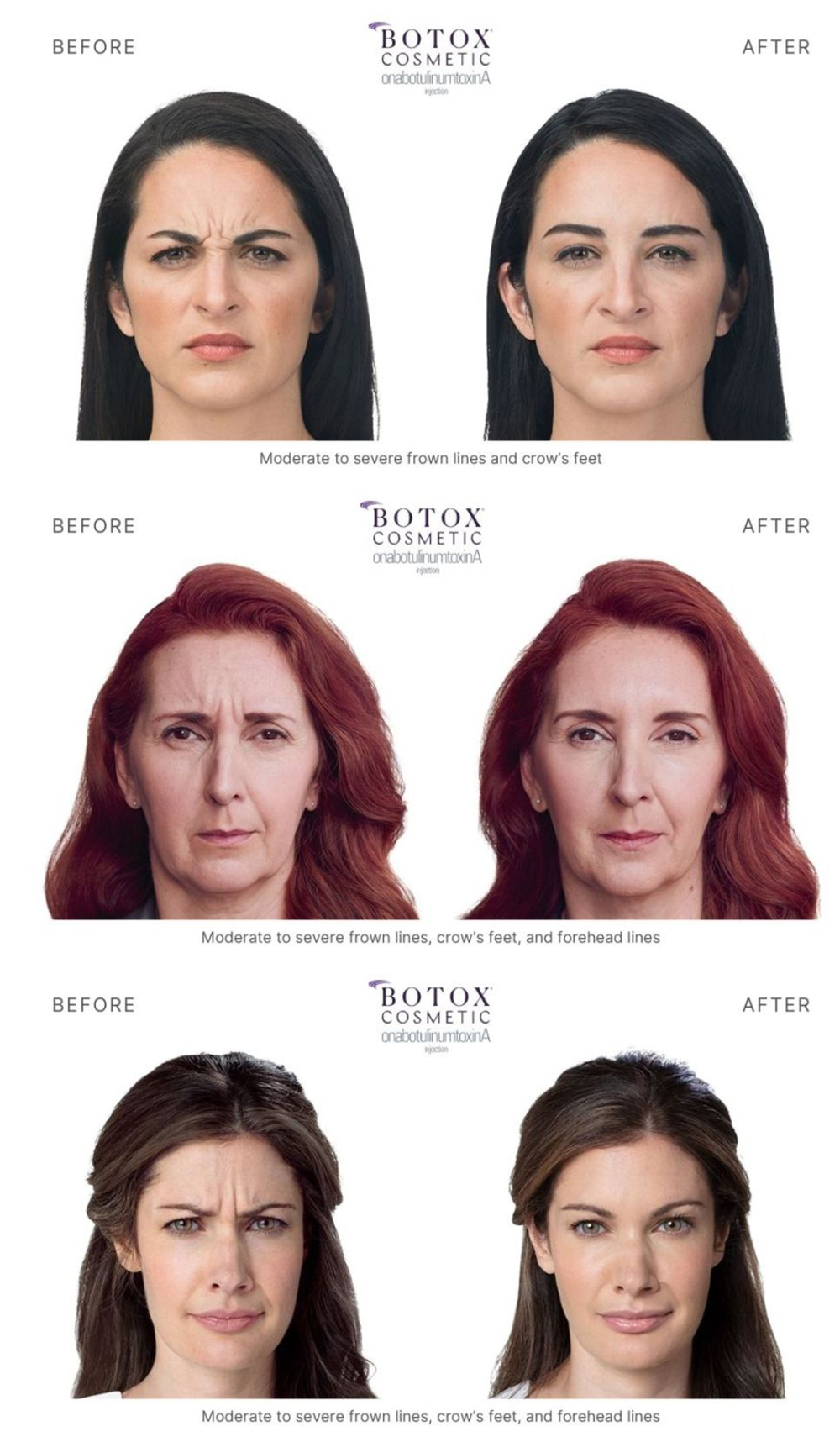 Three women with expression lines before and relaxed facial features after botox.