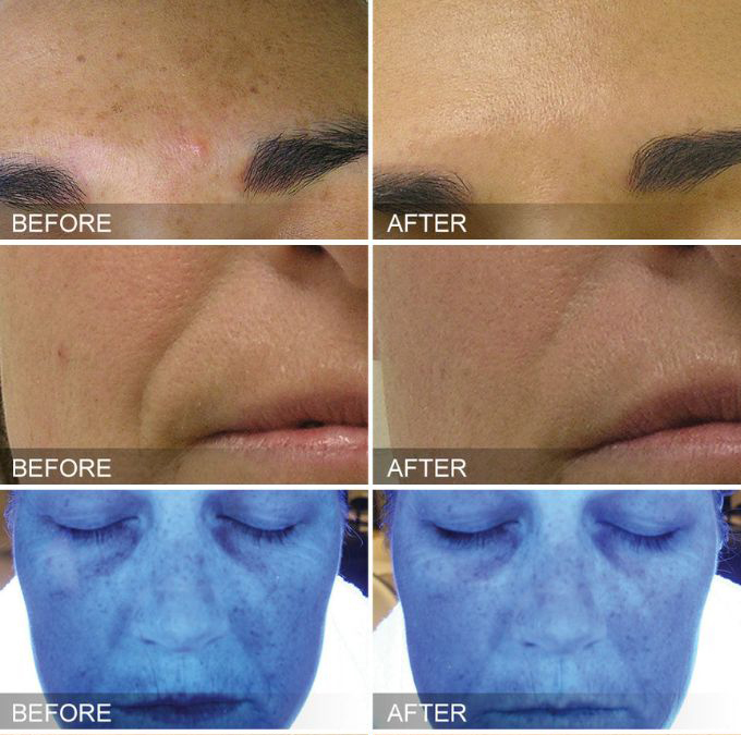 Before and after images showing improved results from hydrafacial treatment in Westport, CT.