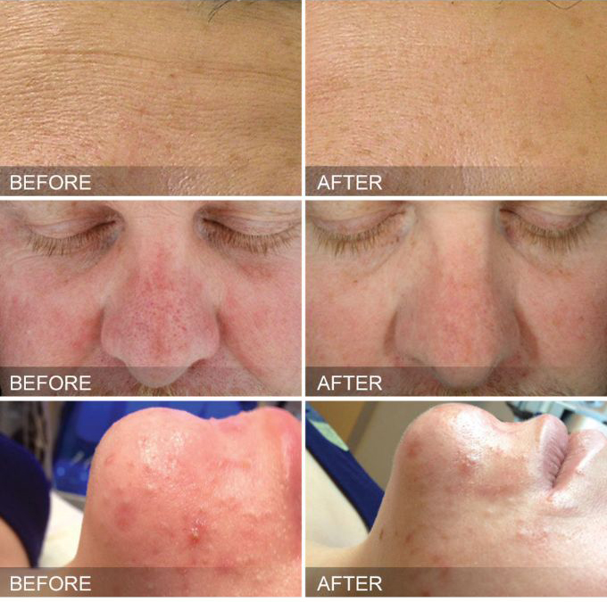 Before and after images showing improved results from hydrafacial treatment in Westport, CT.