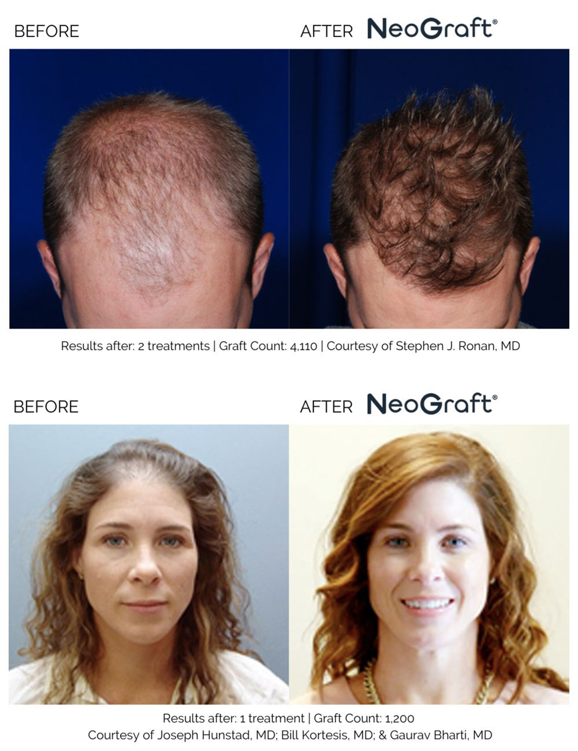 Man and woman before photos showing receding hair compared to after NeoGraft hair transplant restoring a full head of hair.