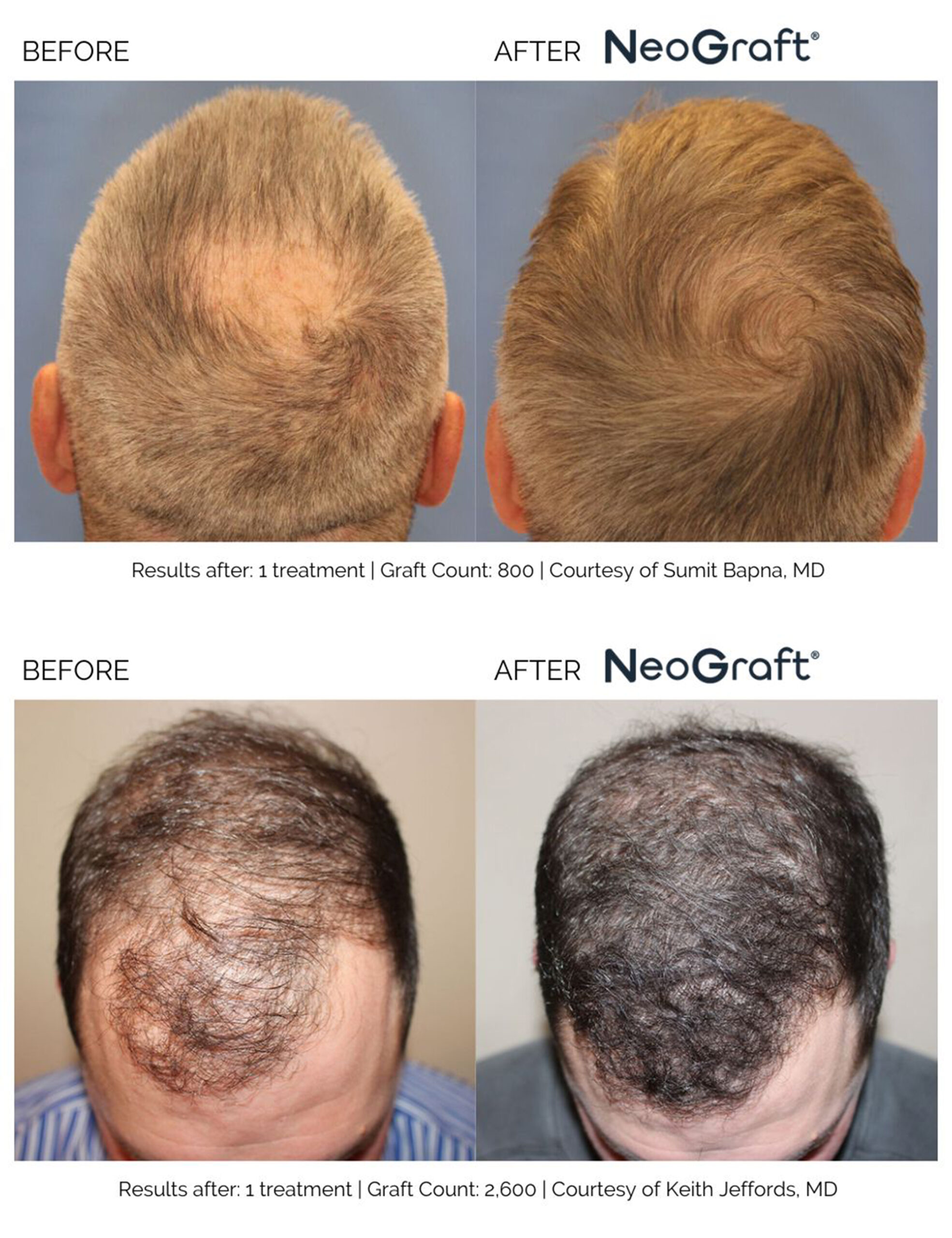 Two men's before photos showing receding hair compared to after NeoGraft hair transplant restoring a full head of hair.