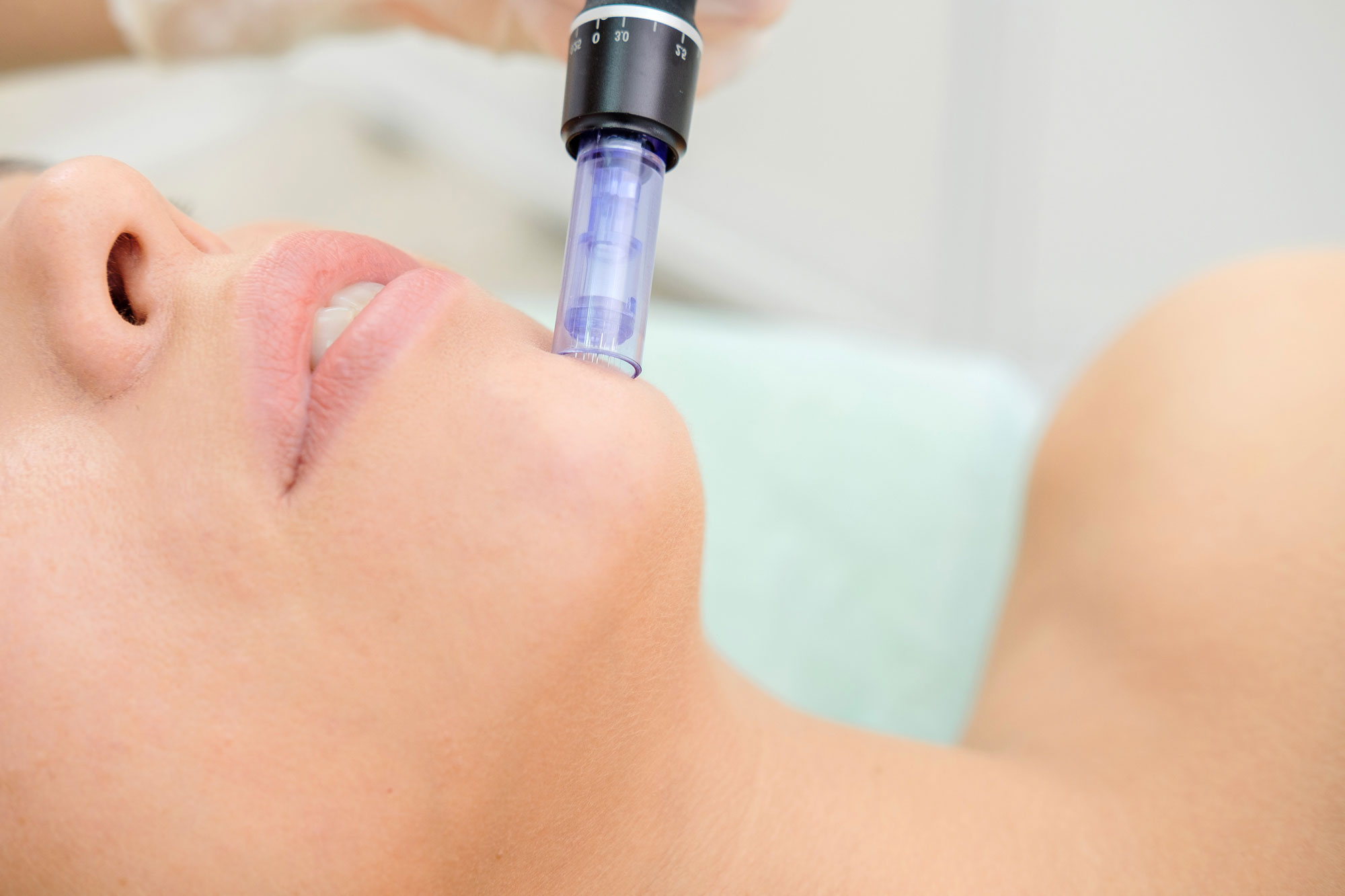 Microneedling collagen induction treatment Close-up of a microneedling device being used on a patient's cheek during a collagen induction therapy treatment